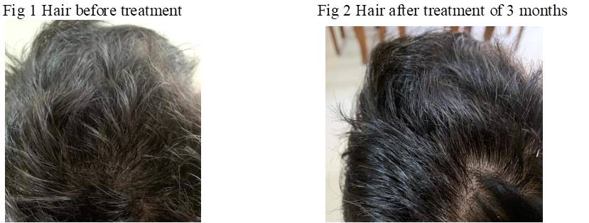 Early greying of hair – Dr Tariq Jagmag